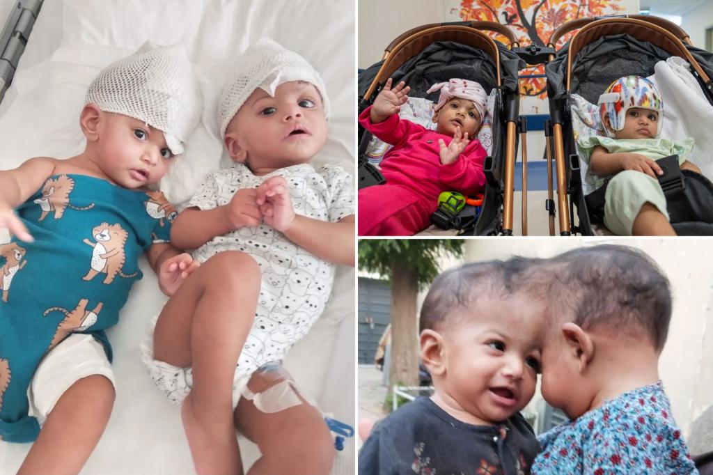 Conjoined twins born with fused brain tissue separated after dangerous 14-hour surgery: 'Truly miraculous'