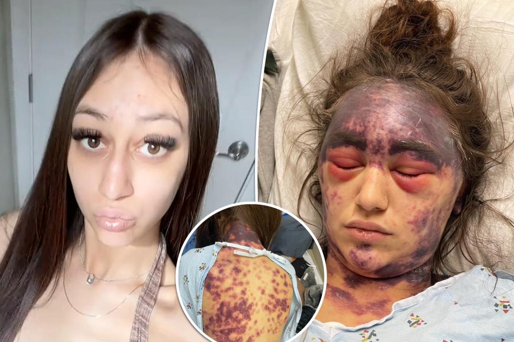 Woman with rare disease claims she is now blind and bruised after doctors forced her to take 3 shots