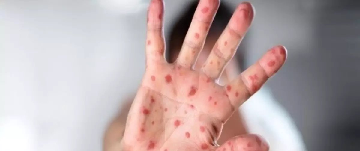 Surto de doença mão-pé-boca atinge 25 crianças em Ocauçu (SP) - Imagem do artigo