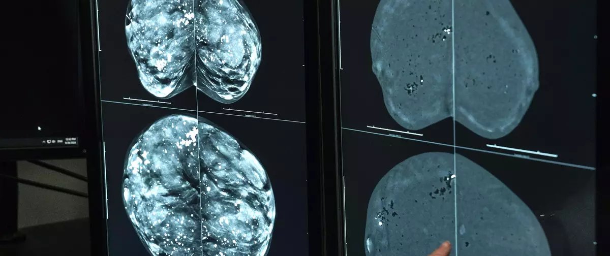 Ministério da Saúde recomenda mamografia a partir dos 40 anos e estende rastreamento até 74 - Imagem do artigo