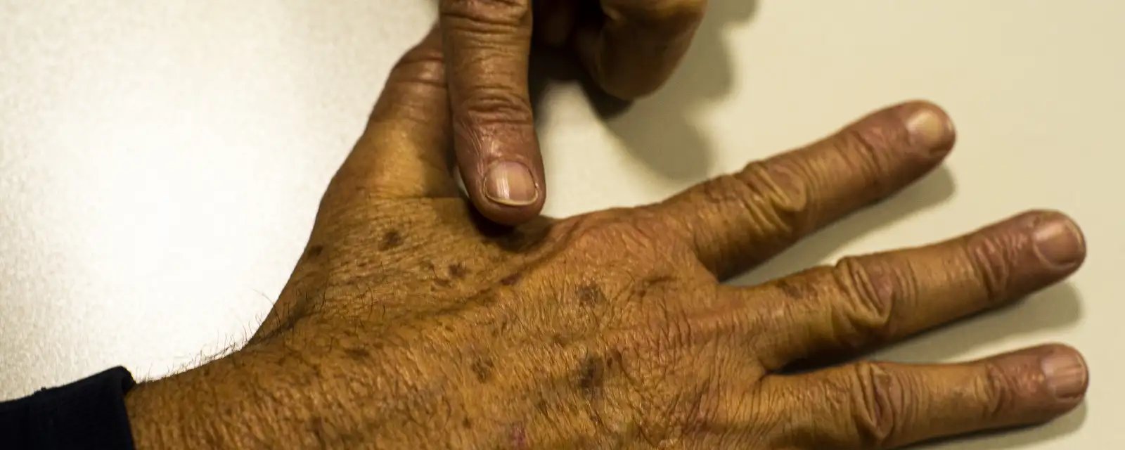 Falta de dados sobre raça e escolaridade dificulta combate ao câncer de pele, aponta estudo - Imagem do artigo