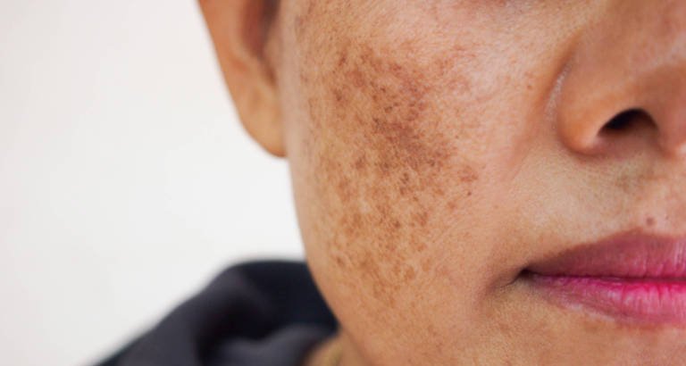 Pesquisas associam dieta antioxidante à prevenção e ao controle do melasma - Imagem do artigo original