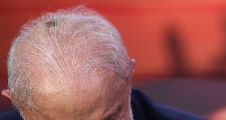 Lula retira carcinoma basocelular da cabeça e passa por infiltração no punho em São Paulo - Imagem do artigo original