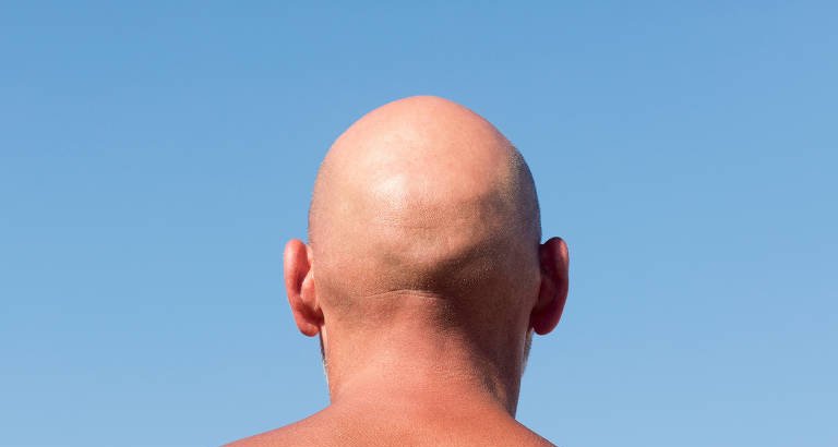 Dermatologistas reforçam necessidade de protetor solar no couro cabeludo de carecas e calvos - Imagem do artigo original